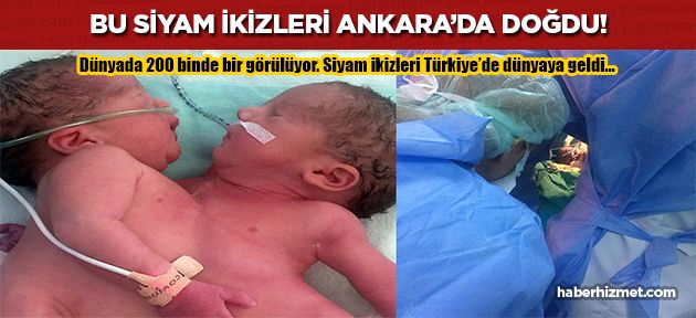 200 binde 1 görülen siyam ikizleri Ankara'da dünyaya geldi!
