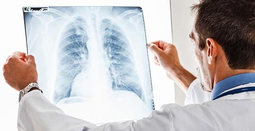 Akciğer Kanseri Tedavisinde İlerleme