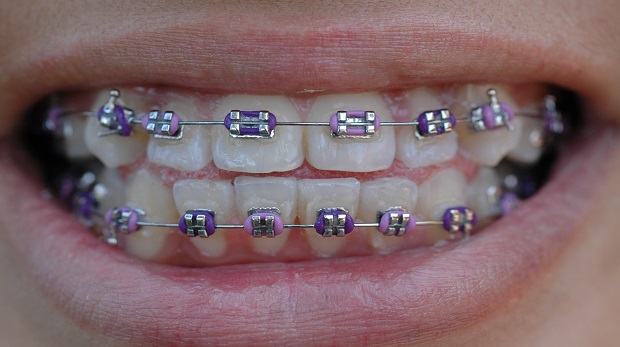 Diş Teli Tedavisinin Yanlış Bilinenleri